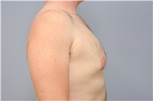 Male Breast Reduction Before Photo by Carlos Rivera-Serrano, MD; Bay Harbour Islands, FL - Case 43709