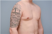 Male Breast Reduction After Photo by Carlos Rivera-Serrano, MD; Carbondale, IL - Case 43710