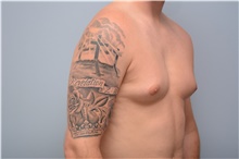 Male Breast Reduction Before Photo by Carlos Rivera-Serrano, MD; Carbondale, IL - Case 43710