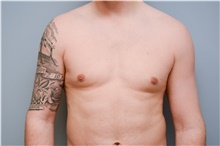 Male Breast Reduction After Photo by Carlos Rivera-Serrano, MD; Bay Harbour Islands, FL - Case 43710