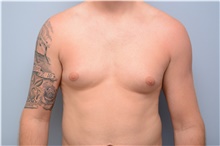 Male Breast Reduction Before Photo by Carlos Rivera-Serrano, MD; Bay Harbour Islands, FL - Case 43710
