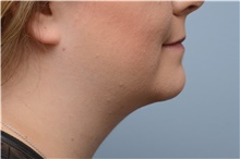 Neck Lift After Photo by Carlos Rivera-Serrano, MD; Bay Harbour Islands, FL - Case 43712