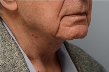 Neck Lift After Photo by Carlos Rivera-Serrano, MD; Bay Harbour Islands, FL - Case 43713