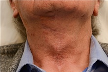 Neck Lift After Photo by Carlos Rivera-Serrano, MD; Bay Harbour Islands, FL - Case 43713