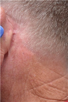 Neck Lift After Photo by Carlos Rivera-Serrano, MD; Bay Harbour Islands, FL - Case 43714