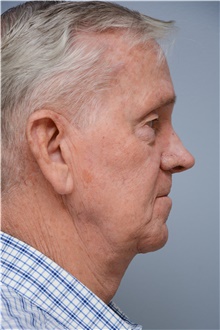 Neck Lift After Photo by Carlos Rivera-Serrano, MD; Bay Harbour Islands, FL - Case 43715
