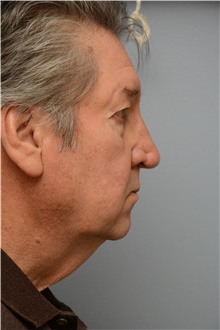 Neck Lift Before Photo by Carlos Rivera-Serrano, MD; Bay Harbour Islands, FL - Case 43716