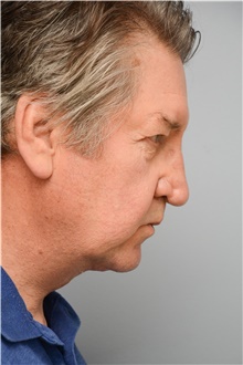 Neck Lift After Photo by Carlos Rivera-Serrano, MD; Bay Harbour Islands, FL - Case 43716