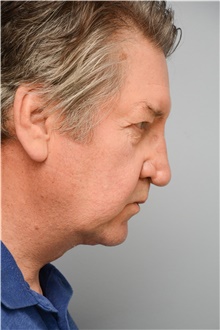 Neck Lift After Photo by Carlos Rivera-Serrano, MD; Miami Beach, FL - Case 43716