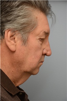 Neck Lift Before Photo by Carlos Rivera-Serrano, MD; Miami Beach, FL - Case 43716