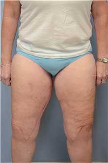 Thigh Lift After Photo by Carlos Rivera-Serrano, MD; Bay Harbour Islands, FL - Case 43747