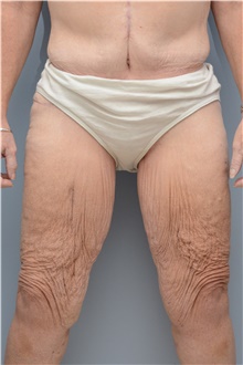 Thigh Lift Before Photo by Carlos Rivera-Serrano, MD; Bay Harbour Islands, FL - Case 43747