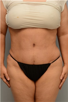 Tummy Tuck After Photo by Carlos Rivera-Serrano, MD; Bay Harbour Islands, FL - Case 43748