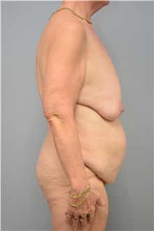 Tummy Tuck Before Photo by Carlos Rivera-Serrano, MD; Bay Harbour Islands, FL - Case 43749