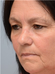 Head and Neck Skin Cancer Reconstruction After Photo by Carlos Rivera-Serrano, MD; Bay Harbour Islands, FL - Case 44381