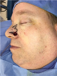 Head and Neck Skin Cancer Reconstruction Before Photo by Carlos Rivera-Serrano, MD; Bay Harbour Islands, FL - Case 44383