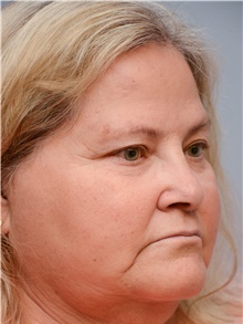 Head and Neck Skin Cancer Reconstruction After Photo by Carlos Rivera-Serrano, MD; Bay Harbour Islands, FL - Case 44384