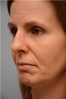 Head and Neck Skin Cancer Reconstruction After Photo by Carlos Rivera-Serrano, MD; Bay Harbour Islands, FL - Case 44386