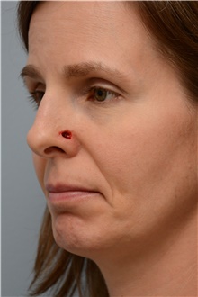 Head and Neck Skin Cancer Reconstruction Before Photo by Carlos Rivera-Serrano, MD; Bay Harbour Islands, FL - Case 44386