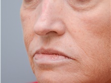 Head and Neck Skin Cancer Reconstruction After Photo by Carlos Rivera-Serrano, MD; Bay Harbour Islands, FL - Case 44387
