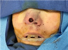 Head and Neck Skin Cancer Reconstruction Before Photo by Carlos Rivera-Serrano, MD; Bay Harbour Islands, FL - Case 44387