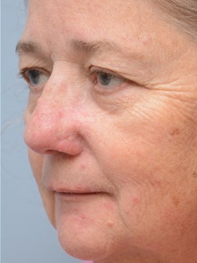 Head and Neck Skin Cancer Reconstruction After Photo by Carlos Rivera-Serrano, MD; Bay Harbour Islands, FL - Case 44388