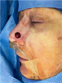 Head and Neck Skin Cancer Reconstruction Before Photo by Carlos Rivera-Serrano, MD; Bay Harbour Islands, FL - Case 44388