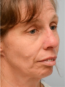 Head and Neck Skin Cancer Reconstruction After Photo by Carlos Rivera-Serrano, MD; Bay Harbour Islands, FL - Case 44389