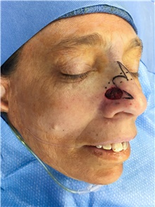 Head and Neck Skin Cancer Reconstruction Before Photo by Carlos Rivera-Serrano, MD; Bay Harbour Islands, FL - Case 44389