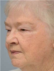 Head and Neck Skin Cancer Reconstruction After Photo by Carlos Rivera-Serrano, MD; Bay Harbour Islands, FL - Case 44390
