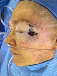 Head and Neck Skin Cancer Reconstruction Before Photo by Carlos Rivera-Serrano, MD; Bay Harbour Islands, FL - Case 44390
