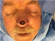 Head and Neck Skin Cancer Reconstruction Before Photo by Carlos Rivera-Serrano, MD; Bay Harbour Islands, FL - Case 44391