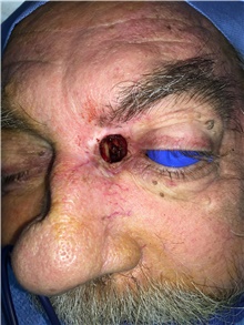 Head and Neck Skin Cancer Reconstruction Before Photo by Carlos Rivera-Serrano, MD; Bay Harbour Islands, FL - Case 44392
