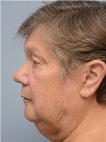 Head and Neck Skin Cancer Reconstruction After Photo by Carlos Rivera-Serrano, MD; Bay Harbour Islands, FL - Case 44394