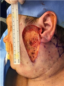 Head and Neck Skin Cancer Reconstruction Before Photo by Carlos Rivera-Serrano, MD; Bay Harbour Islands, FL - Case 44394