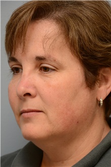 Head and Neck Skin Cancer Reconstruction After Photo by Carlos Rivera-Serrano, MD; Bay Harbour Islands, FL - Case 44395