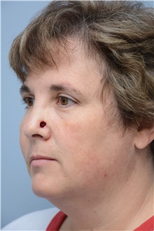 Head and Neck Skin Cancer Reconstruction Before Photo by Carlos Rivera-Serrano, MD; Bay Harbour Islands, FL - Case 44395