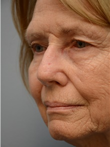 Head and Neck Skin Cancer Reconstruction After Photo by Carlos Rivera-Serrano, MD; Bay Harbour Islands, FL - Case 44396
