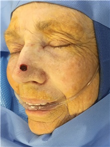 Head and Neck Skin Cancer Reconstruction Before Photo by Carlos Rivera-Serrano, MD; Bay Harbour Islands, FL - Case 44396