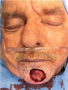 Head and Neck Skin Cancer Reconstruction Before Photo by Carlos Rivera-Serrano, MD; Bay Harbour Islands, FL - Case 44397
