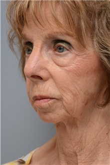 Head and Neck Skin Cancer Reconstruction After Photo by Carlos Rivera-Serrano, MD; Bay Harbour Islands, FL - Case 44402