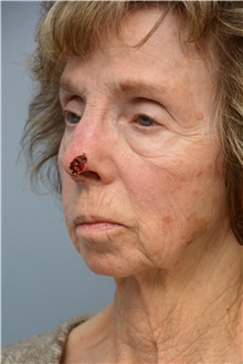 Head and Neck Skin Cancer Reconstruction Before Photo by Carlos Rivera-Serrano, MD; Bay Harbour Islands, FL - Case 44402