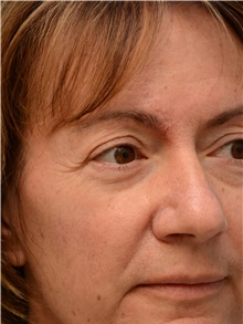 Head and Neck Skin Cancer Reconstruction After Photo by Carlos Rivera-Serrano, MD; Bay Harbour Islands, FL - Case 44403