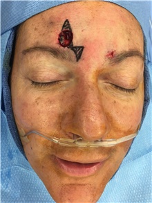 Head and Neck Skin Cancer Reconstruction Before Photo by Carlos Rivera-Serrano, MD; Bay Harbour Islands, FL - Case 44403