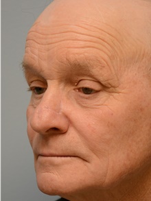 Head and Neck Skin Cancer Reconstruction After Photo by Carlos Rivera-Serrano, MD; Bay Harbour Islands, FL - Case 44404