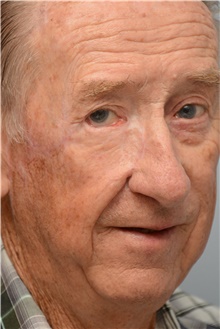 Head and Neck Skin Cancer Reconstruction After Photo by Carlos Rivera-Serrano, MD; Bay Harbour Islands, FL - Case 44405