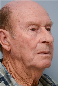 Head and Neck Skin Cancer Reconstruction After Photo by Carlos Rivera-Serrano, MD; Bay Harbour Islands, FL - Case 44406
