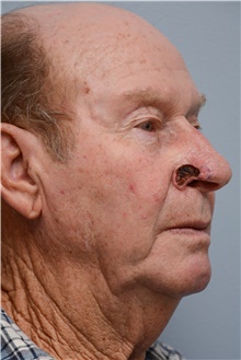 Head and Neck Skin Cancer Reconstruction Before Photo by Carlos Rivera-Serrano, MD; Bay Harbour Islands, FL - Case 44406