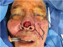 Head and Neck Skin Cancer Reconstruction Before Photo by Carlos Rivera-Serrano, MD; Bay Harbour Islands, FL - Case 44407