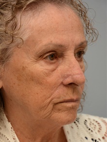 Head and Neck Skin Cancer Reconstruction After Photo by Carlos Rivera-Serrano, MD; Bay Harbour Islands, FL - Case 44410